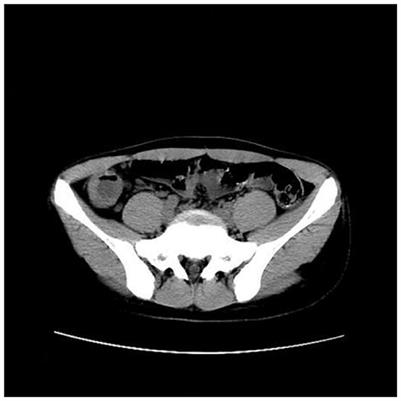First human case report of Crohn's disease with coexistent acute appendicitis treated by endoscopic retrograde appendicitis therapy